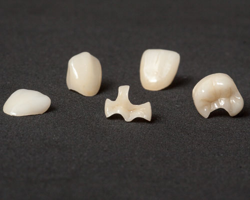 cerec-inlays-onlays